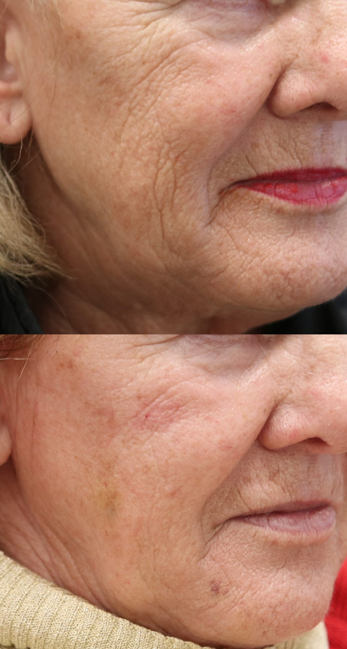 Skin Booster