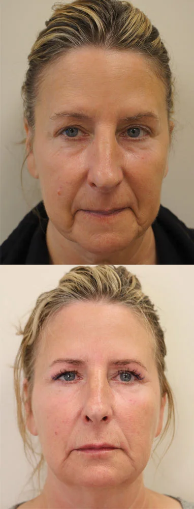 Fillers – Before and After