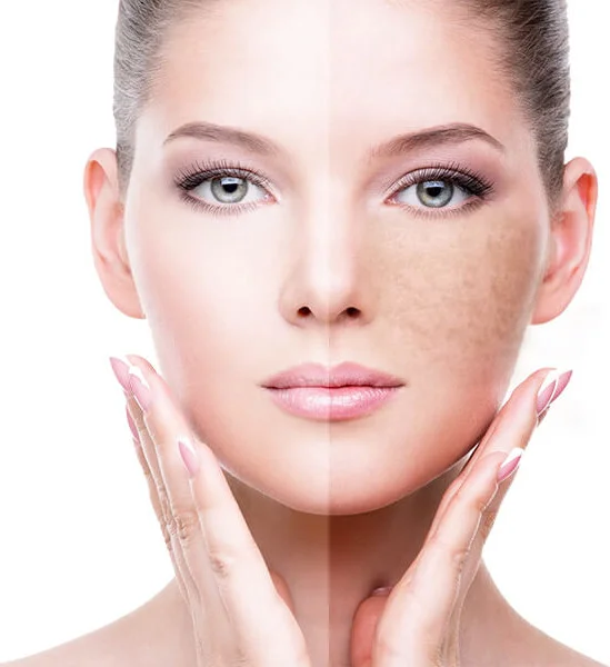 Laser Treatment for Pigment
