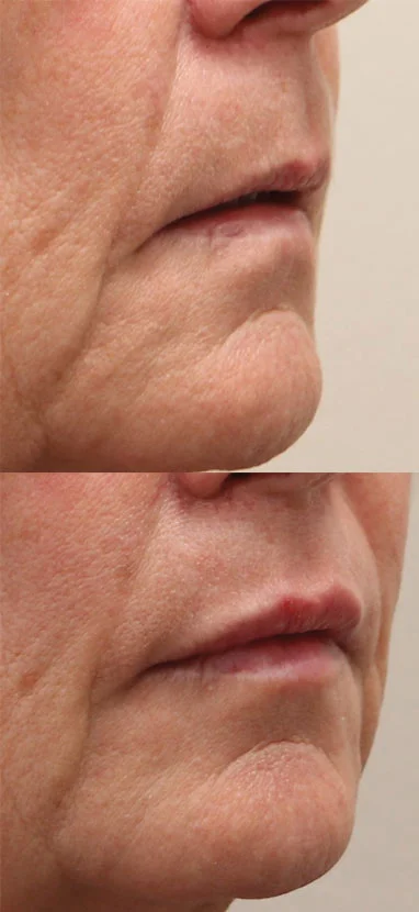 Lip Filler