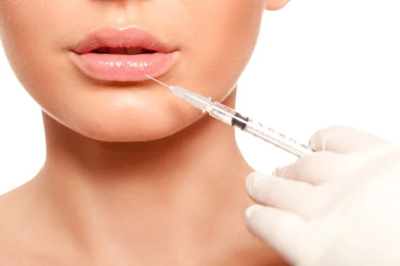 Lip fillers Treatment Edmonton