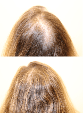 PRP for Hair